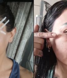 220 bin TL’ye estetik yaptırdı: Yüzünde problemler ortaya çıktı