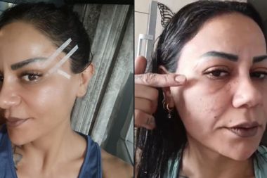 220 bin TL’ye estetik yaptırdı: Yüzünde problemler ortaya çıktı