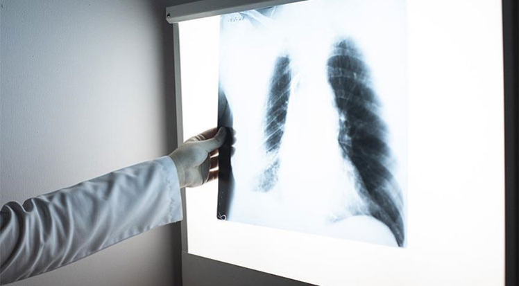 Dünya genelinde her yıl 10 milyondan fazla kişi tüberküloza yakalanıyor