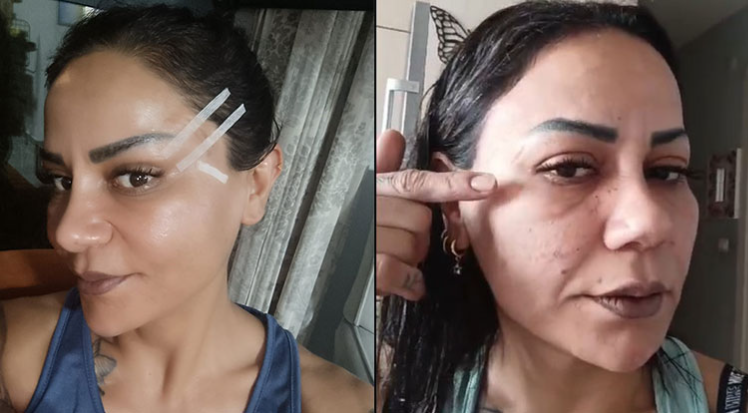 220 bin TL’ye estetik yaptırdı: Yüzünde problemler ortaya çıktı